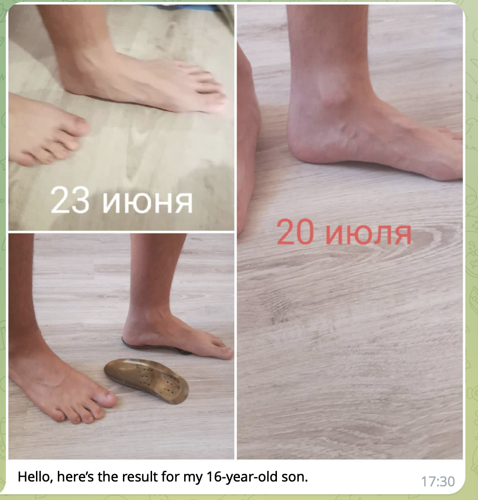 A result of a teen wearing insoles for a month